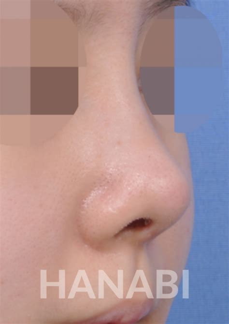 Short nose rhinoplasty – HANABI RHINOPLASTY CLINIC