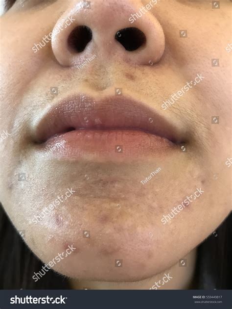 Multiple Acne Scar Around Lips Fat Stock Photo 559449817 | Shutterstock