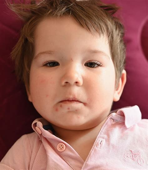 Mild Impetigo Around Mouth