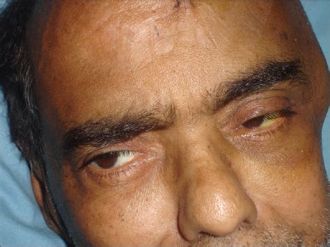 An unusual case of unilateral scleral icterus - PMC