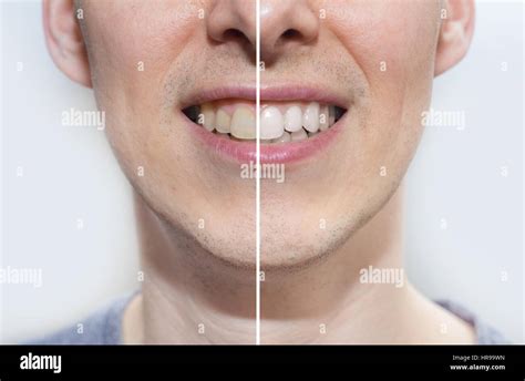 teeth before and after Stock Photo - Alamy