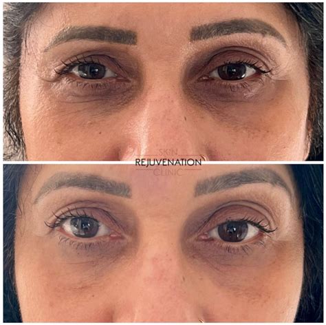 LUMI EYES – UNDER EYE SKIN BOOSTER – Skin Rejuvenation Clinic