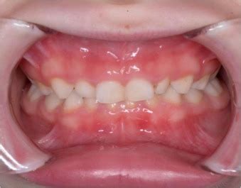 Chronic mucocutaneous candidiasis: a rare diagnosis in paediatric dentistry | Pocket Dentistry