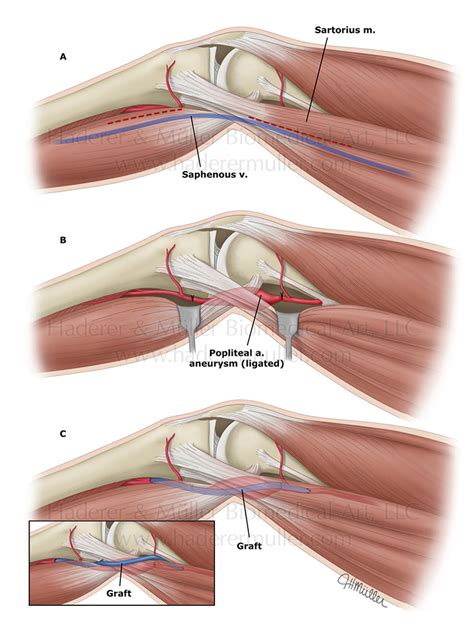 Popliteal Aneurysm