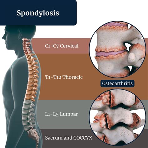 spinal spondylosis treatment irving tx spondylosis surgery  dallas tx