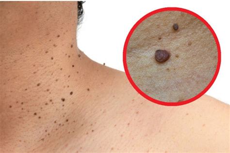 por  salen verrugas en el cuello  hacer   desaparecen