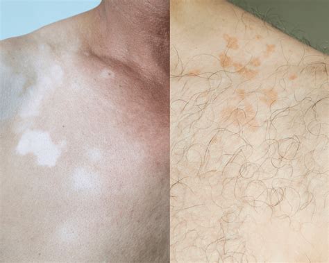 Vitiligo vs Pityriasis Versicolor Uncovered: Mastering the Bright Side - Louis