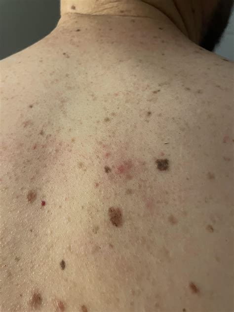 16 best r/skincancer images on Pholder | Mohs was not what I was expecting.
