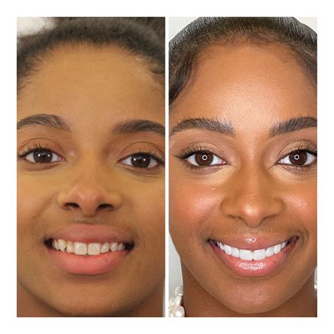 Before & After Gallery | Cosmetic Dentistry Center of NYC