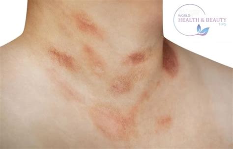 skin rash description   elements   rash types  treatment