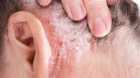 Psoriasis: Entiende sus causas y tratamientos efectivos.