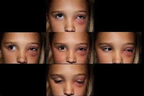 periorbital cellulitis contagious