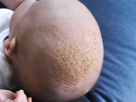 common questions  cradle cap  babies