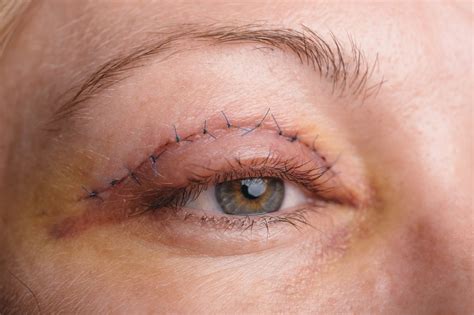 Everything You Need To Know About Droopy Eyelid Surgery | Droopy Eyelid ...