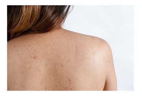 Six ways to get rid of shoulder acne Diy Skin Care, Skin Care Tips ...