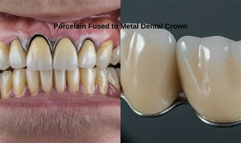 porcelain fused  metal dental crown