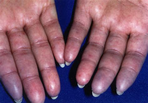 Scleroderma - Harvard Health