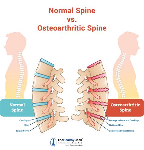 Spinal Arthritis: Causes, Symptoms and Treatments