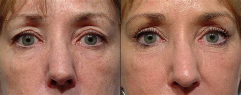 Laser Eyelid Surgery Before And After