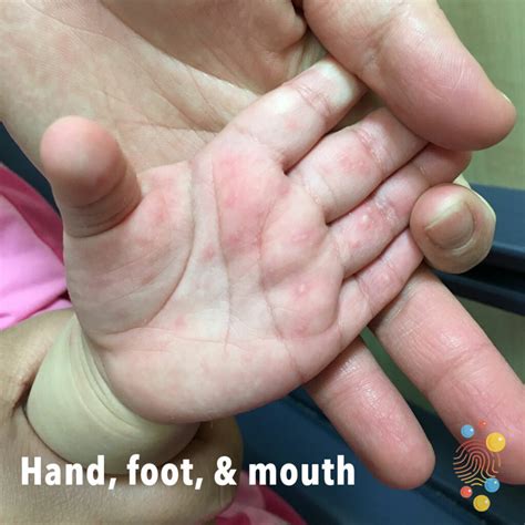 Hand Foot And Mouth Disease Skin Rash Pictures - Captions Hunter