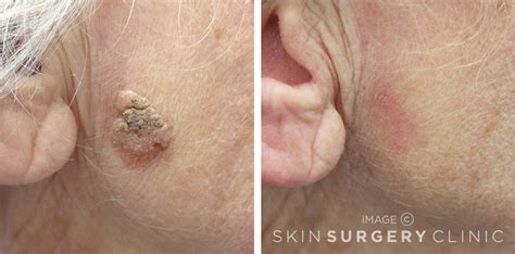 Seborrheic Keratosis Face Removal
