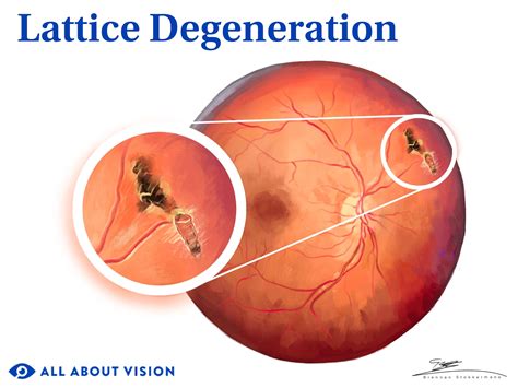 Lattice Degeneration: Risks, Treatment and Symptoms