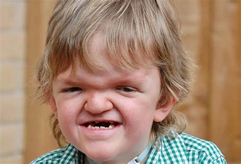 Apert Syndrome: Causes, Symptoms, Diagnosis, Treatment, and Management - Medichimp