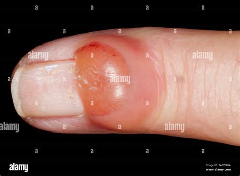 Synovial cyst. Close-up of a large synovial cyst on the finger of a 76 ...