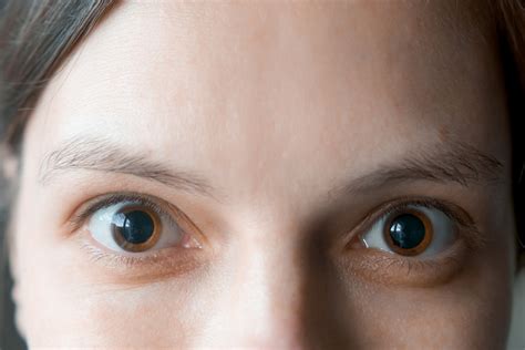 High Eyes: How Pupil Size Can Show Someone Is High on Weed | Zinnia Health