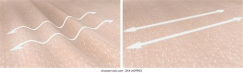 Hyaluronic Acid Injections Face Before After Photos and Images ...