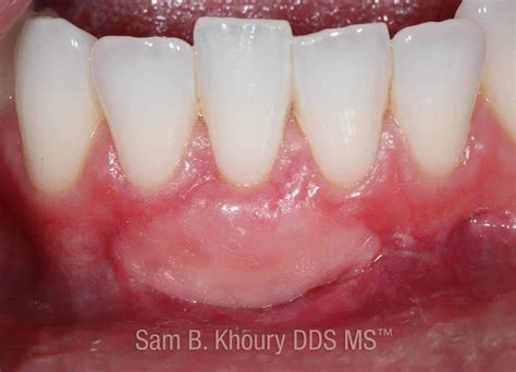 Gum Grafts Before and After - Dr. Sam Khoury