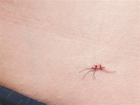 Premium Photo | Suture on the skin of the abdomen close up surgical aid