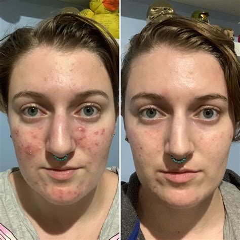 hypothyroidism before and after face 4
