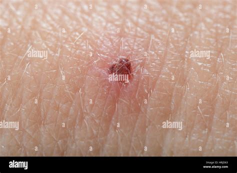 Scab Stock Photo - Alamy