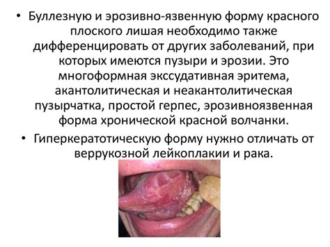 Поражения слизистой оболочки полости рта при дерматозах - online