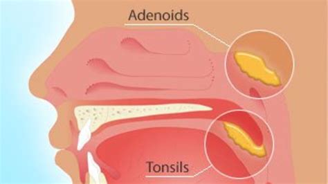 Adenoiditis: Causes And Complications - Ask The Nurse Expert