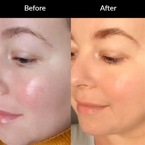 Rosacea vs Eczema: What's the Difference? – Ruddi Skincare