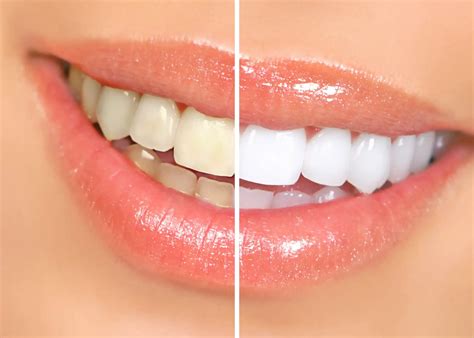 The Truth About Teeth Whitening: Fact vs Fiction