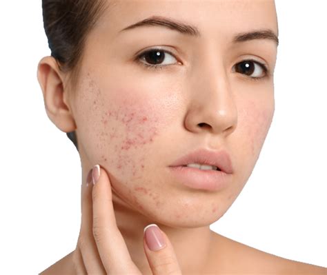 View Cystic Acne Scars Images - Acne problems