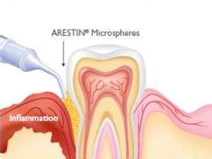 Arestin Local Antibiotic for Gums NYC | Laser Periodontics & Gum Surgery