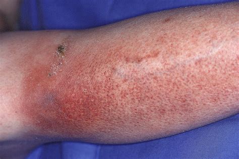 Cellulitis Infection