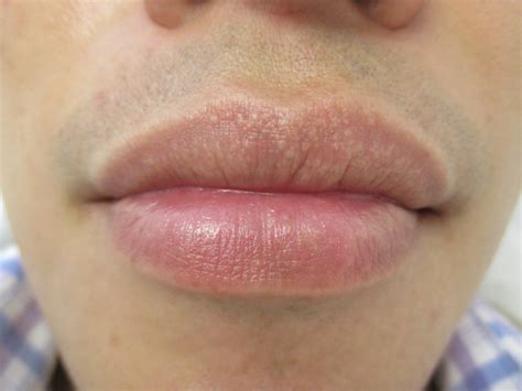 What Causes Fordyce Spots Lips | Lipstutorial.org