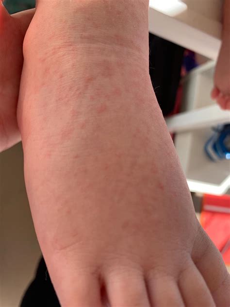 hand foot and mouth disease with pregnant women 6