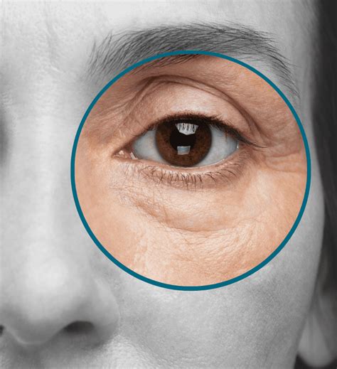 Eye Bags - Perfect Skin Solutions