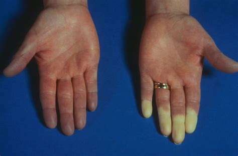 systemic sclerosis signs  symptoms rare disease advisor