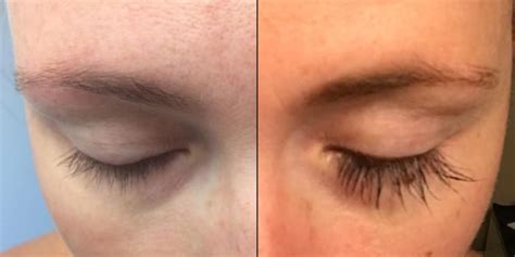 Diy Eyelash Growth Serum Before And After - Health Secrets: Latisse an easy to use lash serum ...