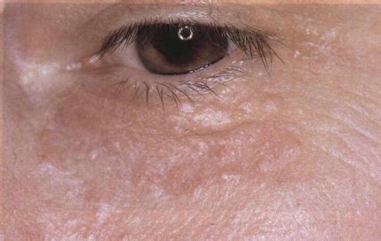 СИРИНГОМА * My dermatology