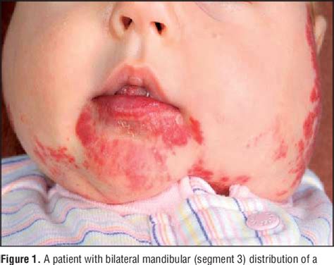 Table 1 from Clinical spectrum and risk of PHACE syndrome in cutaneous ...