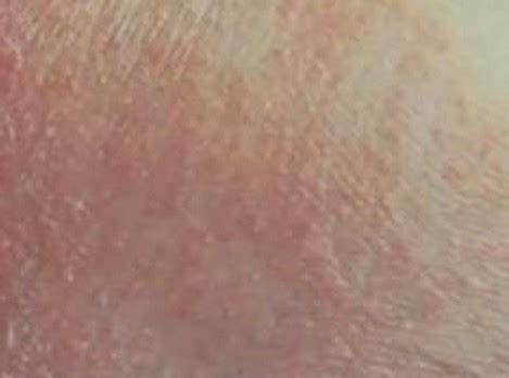 Inner Thigh Rash - Home Remedies, Treatment, Pictures, Causes