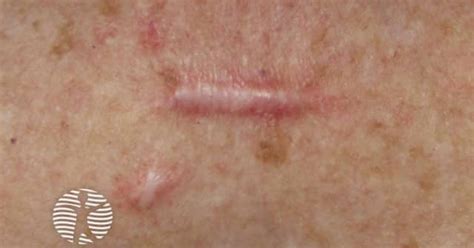 Hypertrophic scar image